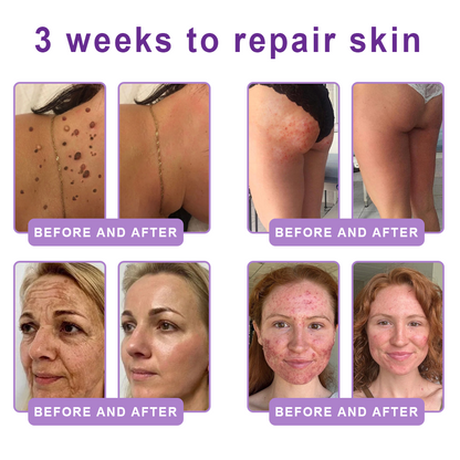 30%OFF 🥇🥇 𝐕𝐢𝐭𝐚𝐥𝐢𝐬𝐲𝐬® 𝐏𝐃𝐑𝐍 𝐌𝐮𝐥𝐭𝐢-𝐏𝐞𝐩𝐭𝐢𝐝𝐞 𝐌𝐚𝐬𝐬𝐚𝐠𝐢𝐧𝐠 𝐁𝐨𝐝𝐲 𝐑𝐨𝐥𝐥𝐞𝐫 𝐂𝐫𝐞𝐚𝐦- Anti-aging, Hydrating, Skin Firming & Lifting, Skin Repair, Even Tone, Acne and Dark Spot Treatment, Wart and Mole Removal, and Psoriasis Relief.