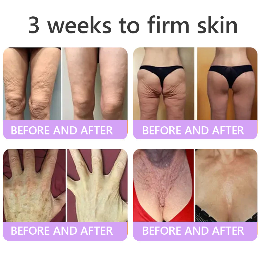 30%OFF 🥇🥇 𝐕𝐢𝐭𝐚𝐥𝐢𝐬𝐲𝐬® 𝐏𝐃𝐑𝐍 𝐌𝐮𝐥𝐭𝐢-𝐏𝐞𝐩𝐭𝐢𝐝𝐞 𝐌𝐚𝐬𝐬𝐚𝐠𝐢𝐧𝐠 𝐁𝐨𝐝𝐲 𝐑𝐨𝐥𝐥𝐞𝐫 𝐂𝐫𝐞𝐚𝐦- Anti-aging, Hydrating, Skin Firming & Lifting, Skin Repair, Even Tone, Acne and Dark Spot Treatment, Wart and Mole Removal, and Psoriasis Relief.
