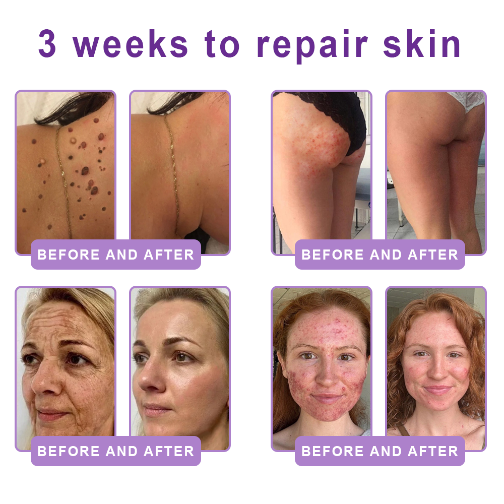 💎Vitalisys® PDRN Multi-Peptide Massaging Body Roller Cream- Anti-aging, Hydrating, Skin Firming & Lifting, Skin Repair, Even Tone, Acne and Dark Spot Treatment, Wart and Mole Removal, and Psoriasis Relief.